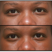 Close up of a woman's face before and after applying the Cheer Up vitamin c under eye cream