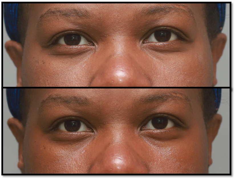 Close up of a woman's face before and after applying the Cheer Up vitamin c under eye cream